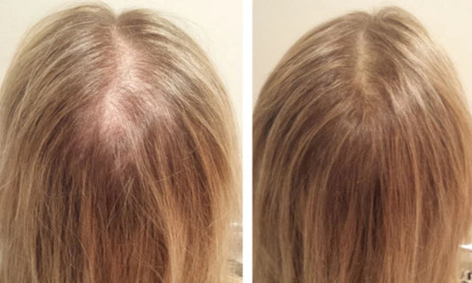 Red Light Therapy For Hair Growth